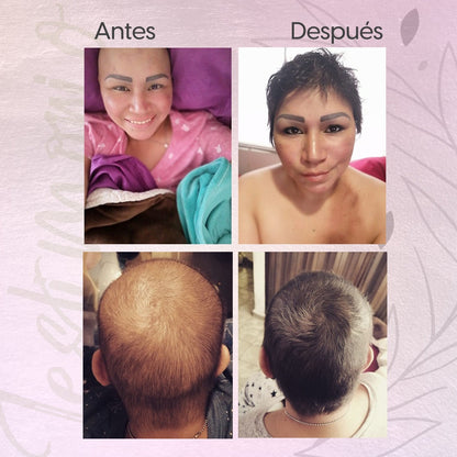 KIT SHAMPOO ANTI CAIDA DAMA