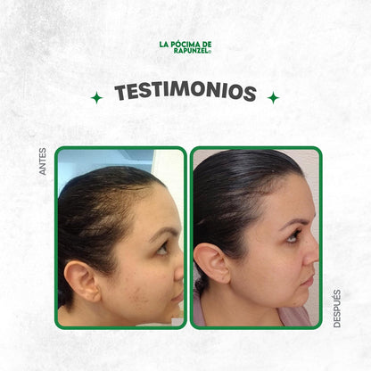 KIT SHAMPOO ANTI CAIDA DAMA