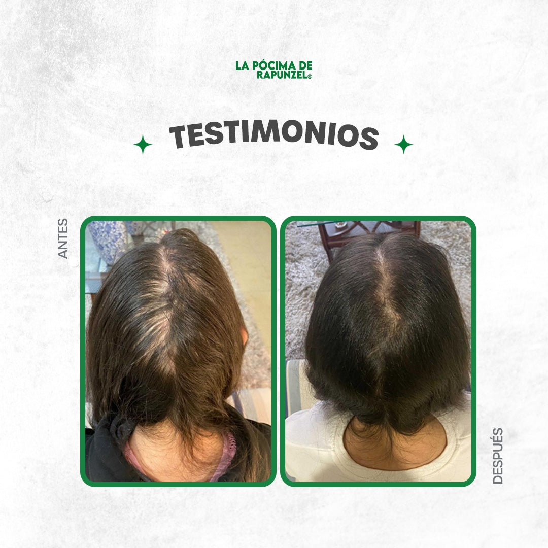 KIT SHAMPOO ANTI CAIDA DAMA