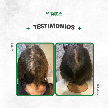 KIT SHAMPOO ANTI CAIDA DAMA