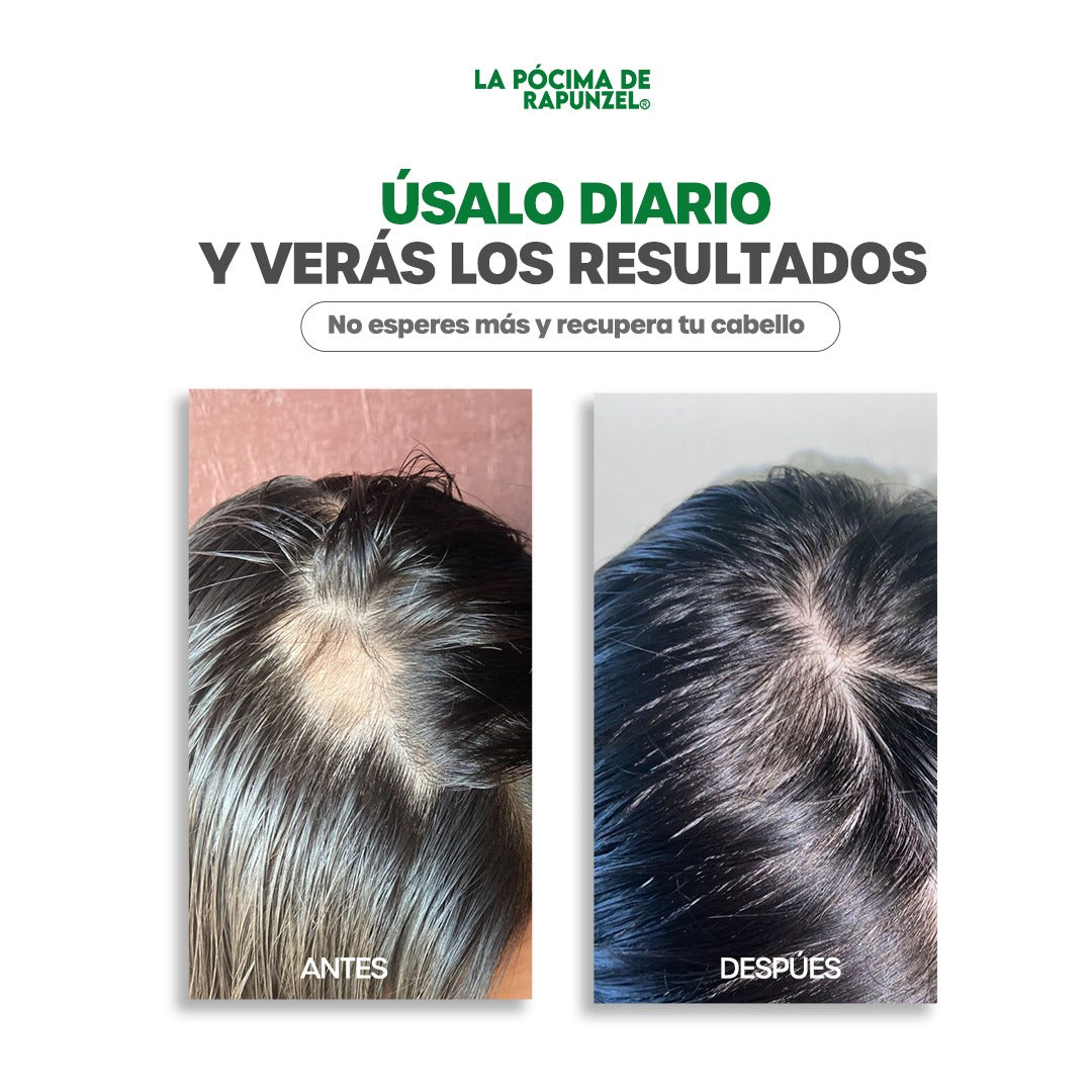 KIT SHAMPOO ANTI CAIDA DAMA