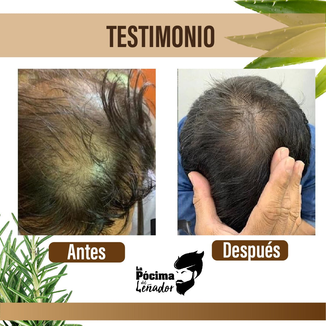 KIT SHAMPOO ANTI CAIDA CABALLERO