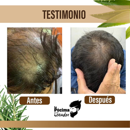 KIT SHAMPOO ANTI CAIDA CABALLERO